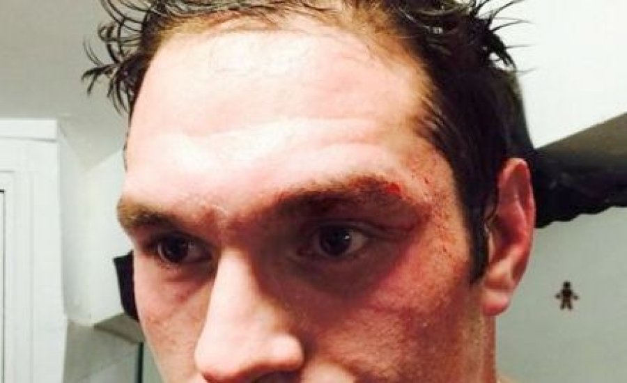 Tyson Fury megsérült, de bokszol